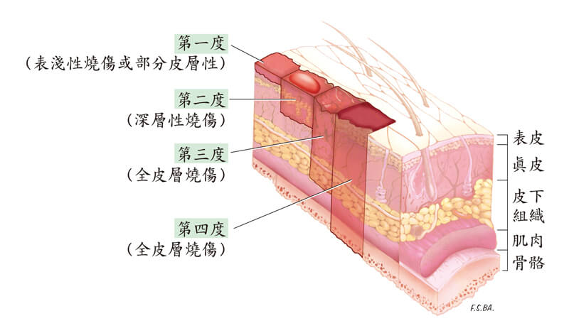 燒燙傷分級